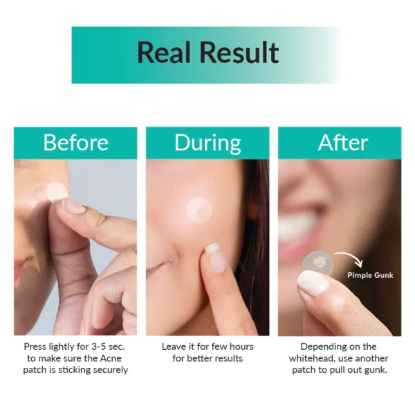 SOMEBYMi Clear Spot Patch (18 patches) - Image 2